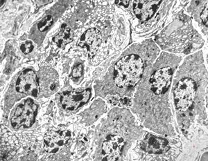 celiakia- plasmocytes in lamina propria